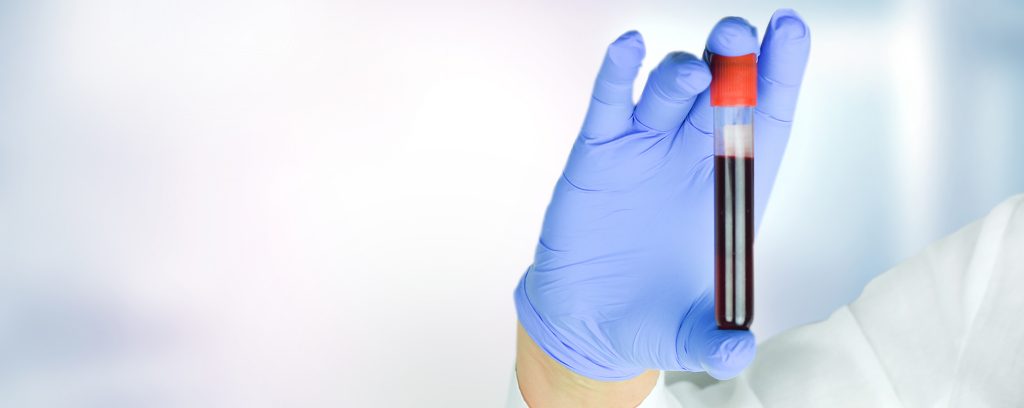 doctor holding test tube with blood in hand